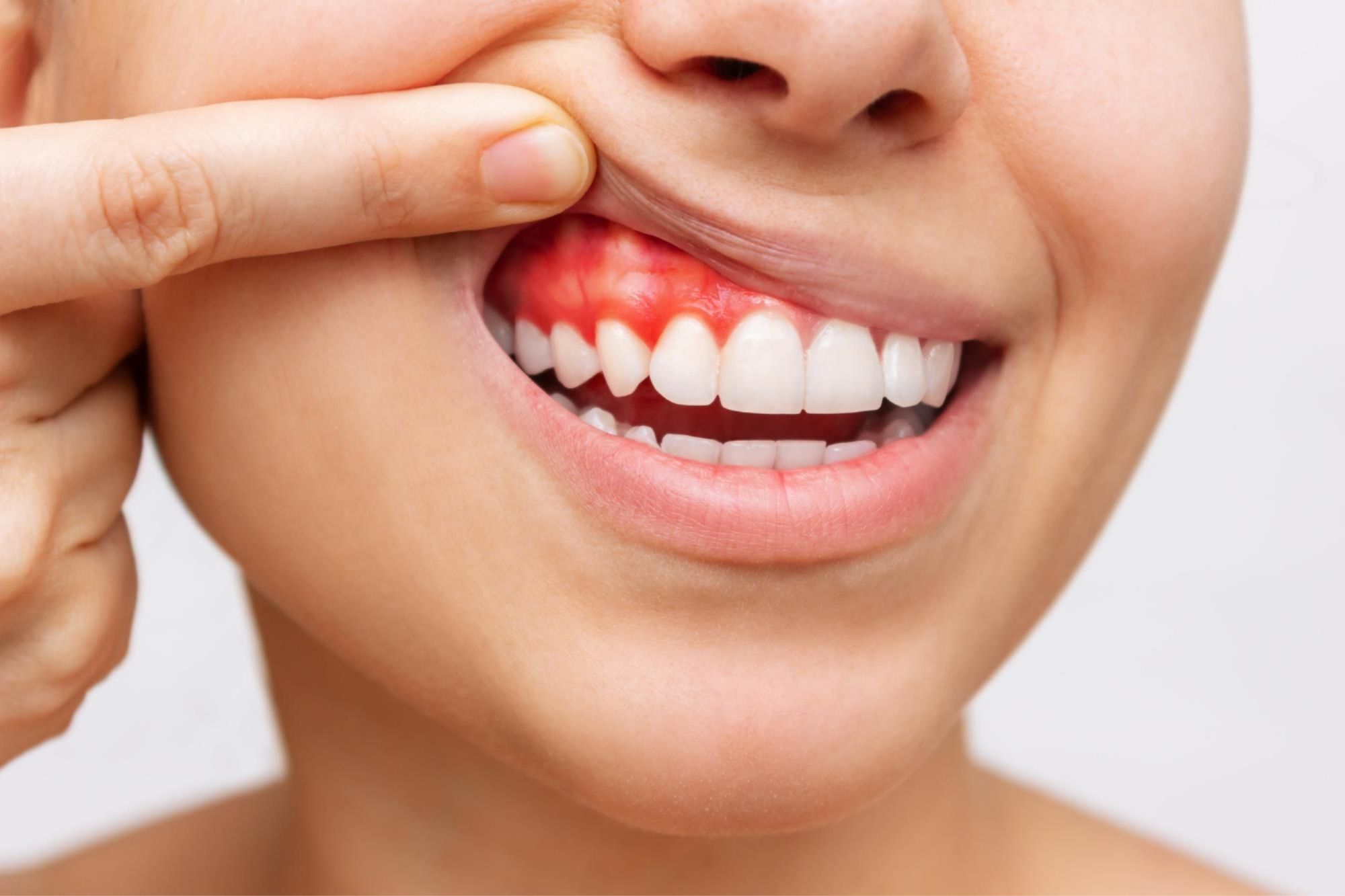 Gum Contouring in Melbourne