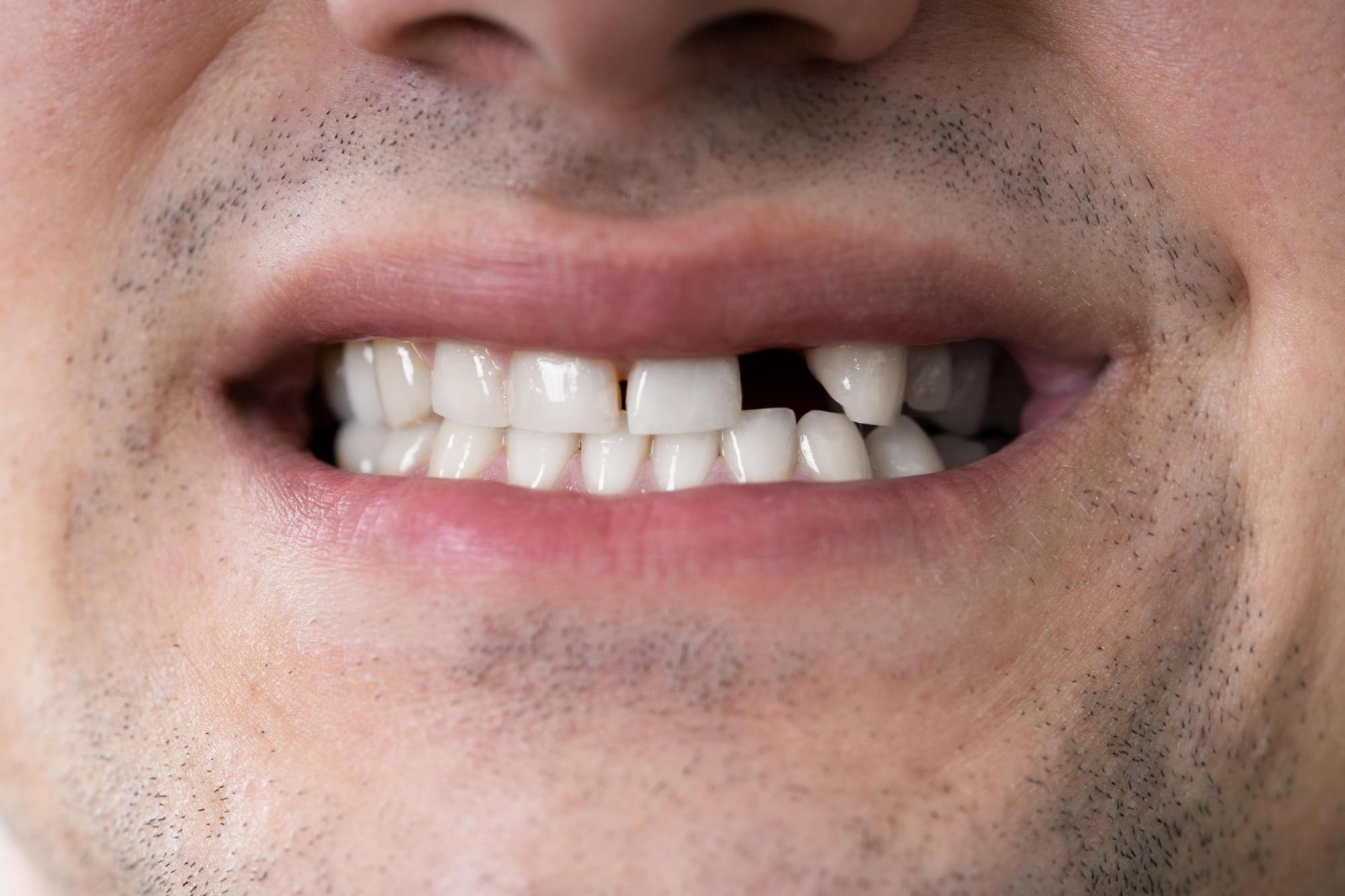dental implants in melbourne