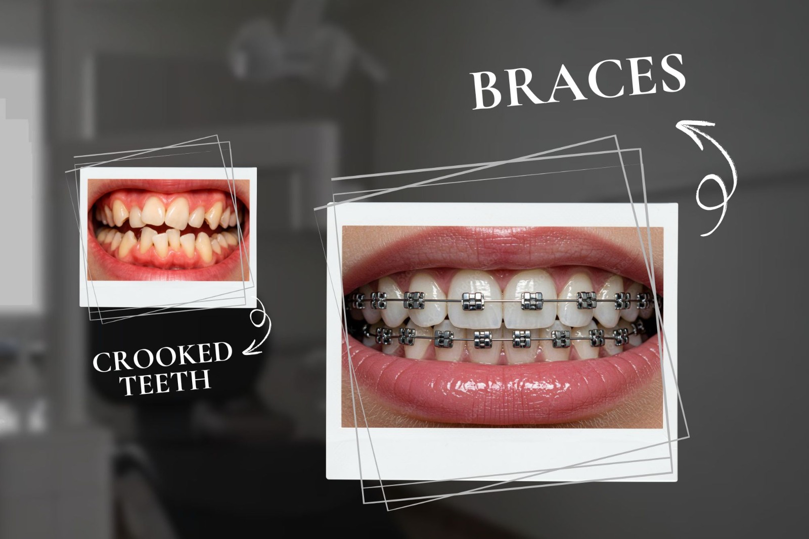 Braces Treatment near me